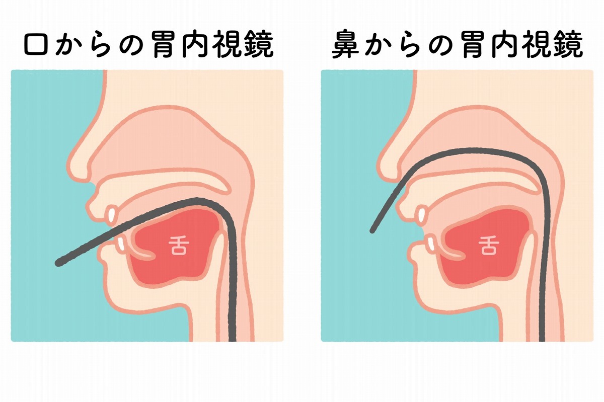 経口・経鼻どちらでも選択可能