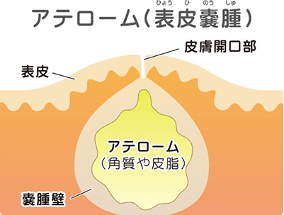 粉瘤とは