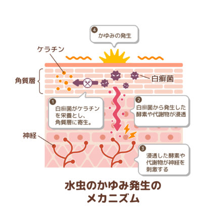 水虫を発症する理由